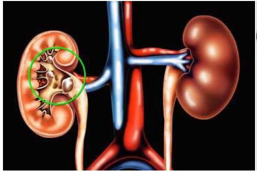 A Review on Kidney Stone and Its              Herbal Treatment