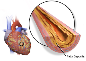Garlic and Heart Disease1–3