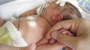 152 میلیون نوزاد نارس در دهه گذشته متولد شده اند