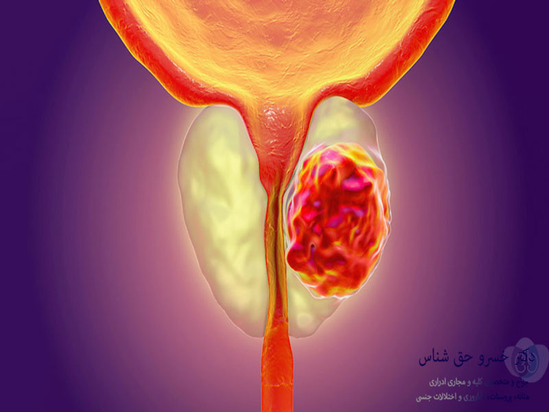 Therapeutic potentials of curcumin in prostate cancer a comprehensive review of pathways and clinical prospects